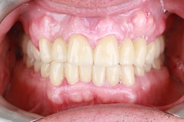 Clínica Dental San Vicente piezas dentales